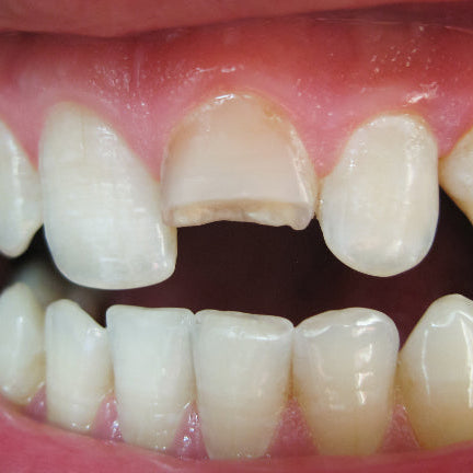 I'VE LOST A FRONT TOOTH - WHAT DO I DO?