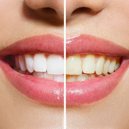 WEDDING SEASON IS COMING: GET YOUR BRIGHTEST SMILE WITH PROFESSIONAL TEETH WHITENING