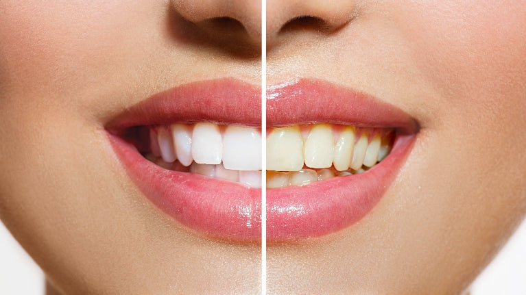 WEDDING SEASON IS COMING: GET YOUR BRIGHTEST SMILE WITH PROFESSIONAL TEETH WHITENING